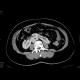 Ren arcuatus, horseshoe kidney: CT - Computed tomography